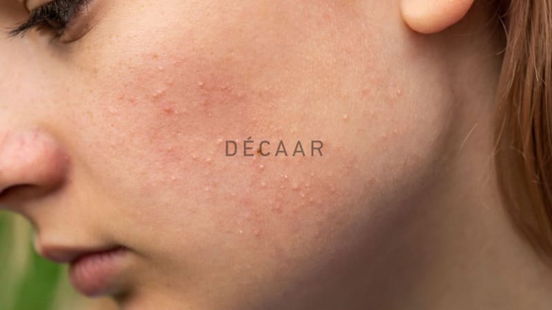 Cách Trị Mụn Ẩn Cho Da Nhạy Cảm